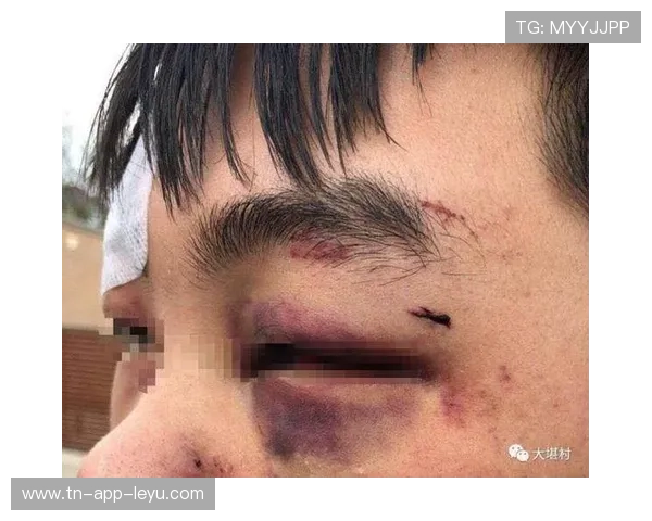 伤病的代价：眉骨开裂与韧带断裂的瞬间，眉骨裂开怎么办